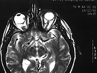 MRI