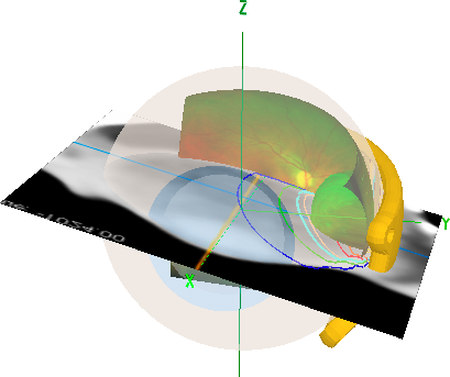 T-MeridianPlaneFusion.png