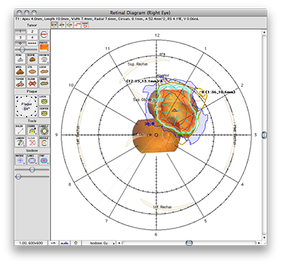 DiagramWithIsodose