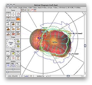 IT45RetinaDosimetry
