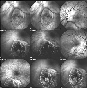 Retina