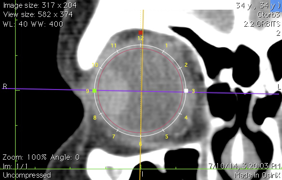 TCoronalCalibrated